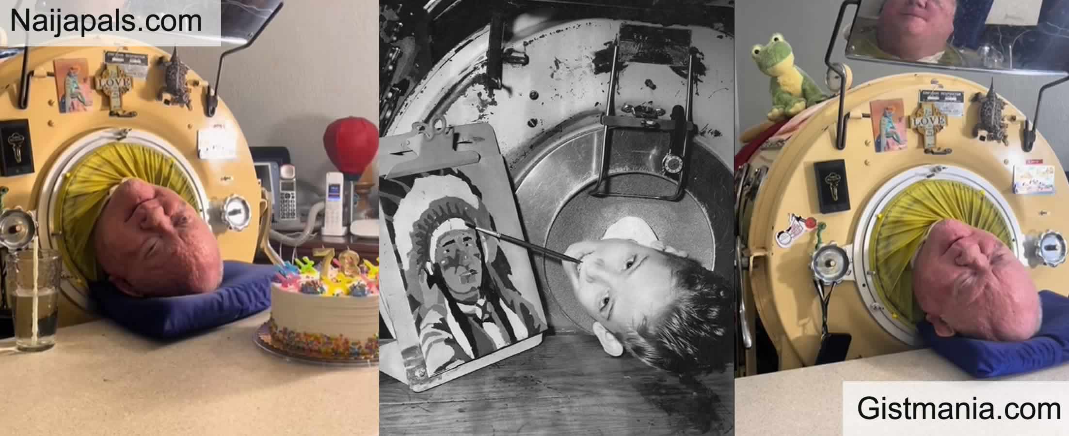 Iron Lung Man Paul Alexander Dies At 78 After Spending 70 Years Living Inside Iron Tank Gistmania