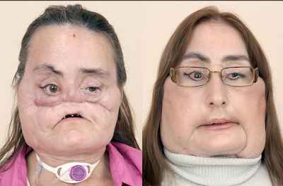 surgery%20woman3 UNBELIEVABLE: Meet The First Person To Undergo Face Transplant -SEE PHOTOS