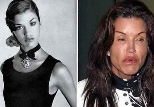 From Beauty To Beast!: Check Out How Plastic Surgery Deformed These 10 ...